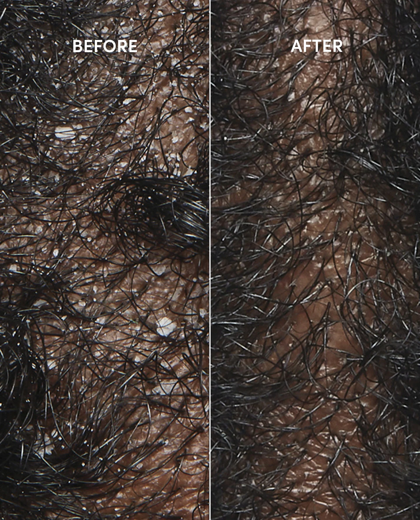 Anti-Dandruff Hair Shampoo